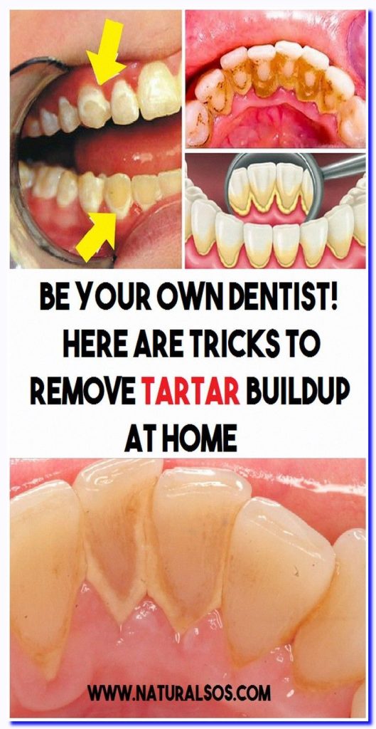 Content image for Stubborn Tartar Buildup? Powerful Ways to Clean Without the Dentist!
