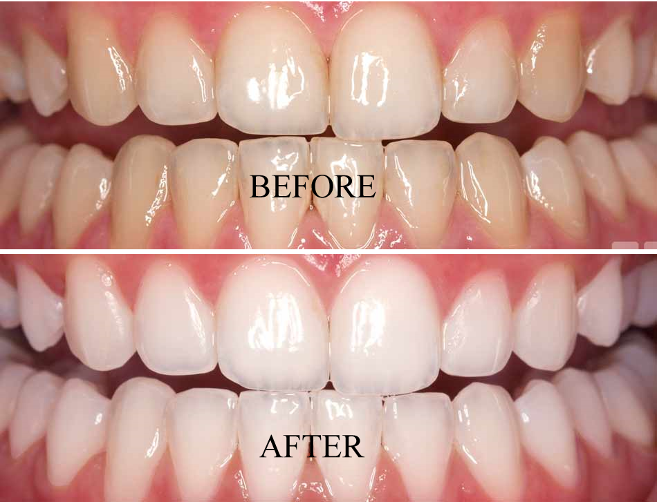 Content image for Yellow Teeth Got You Down? 5 Affordable Whitening Methods