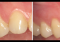 Featured image for Gum Massage? Secret to Healthy, Strong Gums