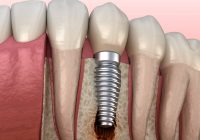Featured image for Troubled Dental Implants? Recognize Symptoms and Solutions