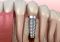 Featured image for Troubled Dental Implants? Recognize Symptoms and Solutions