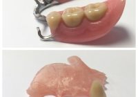 Featured image for Missing Teeth? Choosing the Right Denture Option