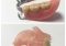 Featured image for Missing Teeth? Choosing the Right Denture Option