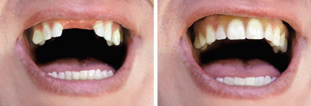 Content image for Missing Teeth? Choosing the Right Denture Option