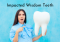 Featured image for Impacted Wisdom Teeth? Pain-Free Solutions