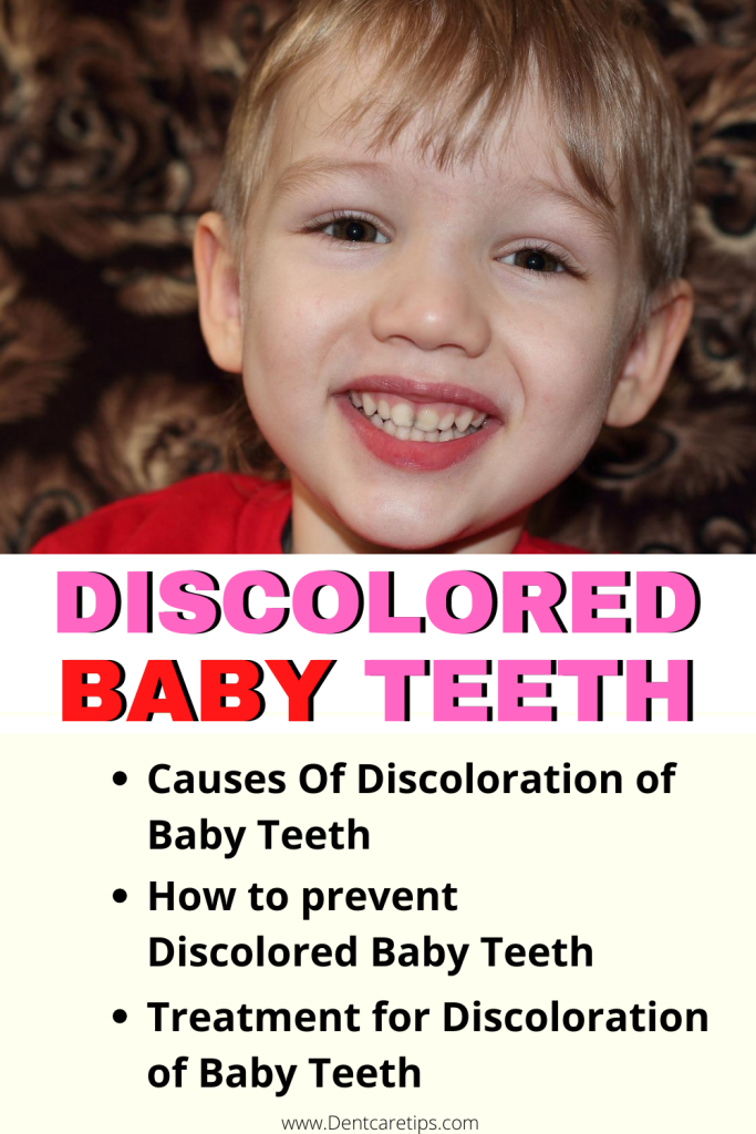 Content image for Blackened Baby Teeth? Causes and Solutions
