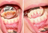 Featured image for Does Tartar Cause Loose Teeth? The Real Facts
