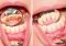 Featured image for Does Tartar Cause Loose Teeth? The Real Facts