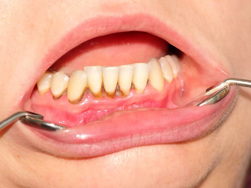 Content image for Does Tartar Cause Loose Teeth? The Real Facts