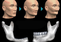 Featured image for Do Dentures Cause Jawbone Loss? The Truth