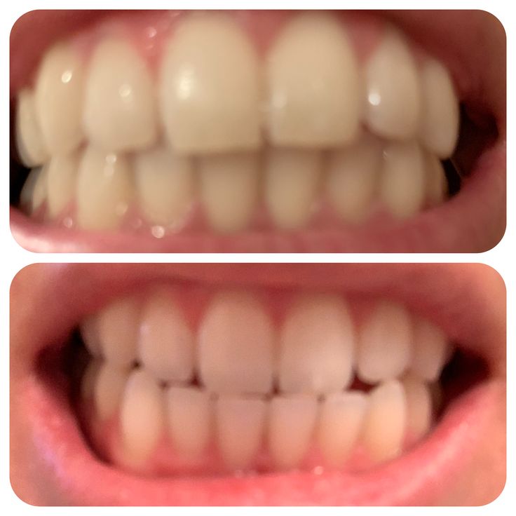 Content image for Sensitivity from Whitening Toothpaste? The Explanation