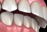 Featured image for Is Overbite Hereditary? The Science Behind It
