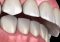 Featured image for Is Overbite Hereditary? The Science Behind It