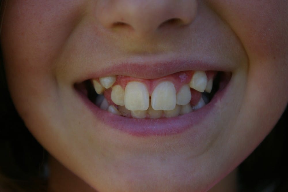 Content image for Is Overbite Hereditary? The Science Behind It