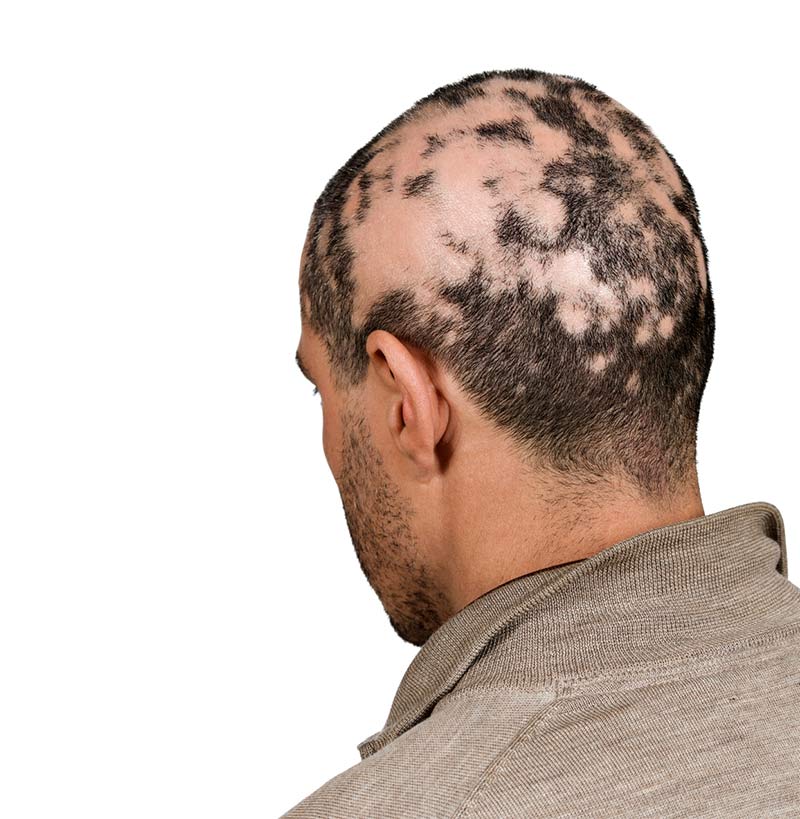 Content image for Hair Loss Due to Autoimmune Diseases: Recognize the Symptoms