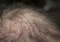 Featured image for Hair Loss Due to Genetic Factors: Can It Be Prevented?