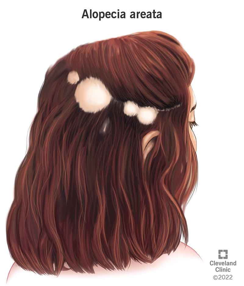 Content image for Alopecia Areata: Causes, Symptoms, and Treatment