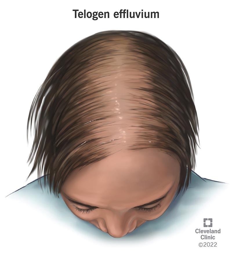 Content image for Telogen Effluvium: Worrisome Hair Loss