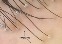 Featured image for Cicatricial Alopecia: Permanent Hair Loss