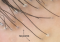 Featured image for Cicatricial Alopecia: Permanent Hair Loss