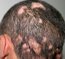 Content image for Hair Loss Due to Tinea Capitis: Fungal Infection