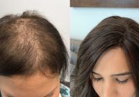 Featured image for Hair Loss Due to Chemotherapy: Post-Chemo Care
