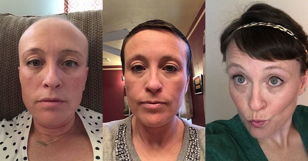 Content image for Hair Loss Due to Chemotherapy: Post-Chemo Care