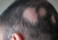 Featured image for Hair Loss Due to Lupus: Autoimmune Disease