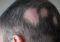 Featured image for Hair Loss Due to Lupus: Autoimmune Disease
