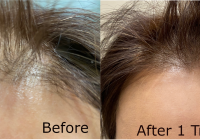Featured image for PRP Therapy: Hair Treatment with Platelet-Rich Plasma