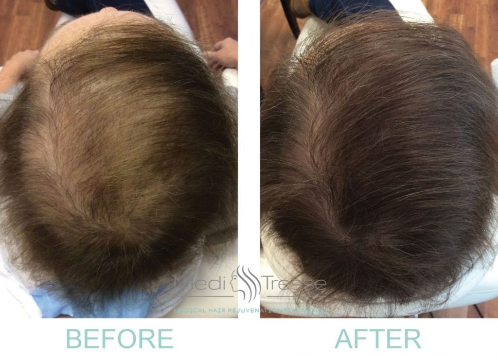 Content image for PRP Therapy: Hair Treatment with Platelet-Rich Plasma