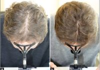 Featured image for Laser Therapy: Hair Treatment with Laser Light