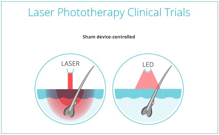 Content image for Laser Therapy: Hair Treatment with Laser Light