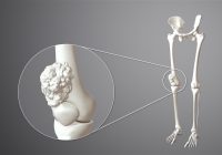 Featured image for Cancer: Types, Symptoms, and New Treatment Hopes