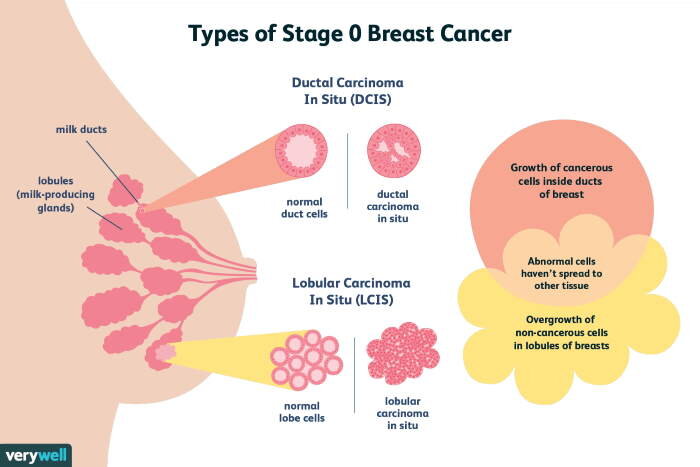 Content image for Cancer: Types, Symptoms, and New Treatment Hopes