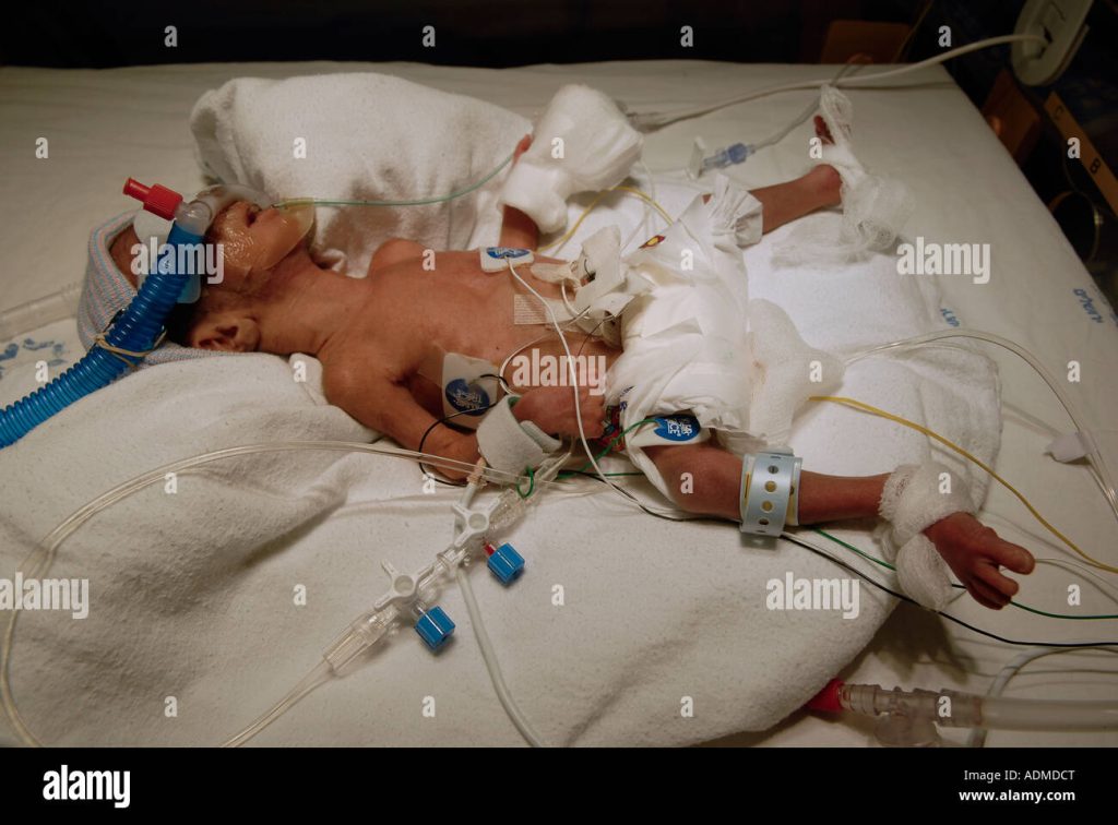 Content image for Premature Baby Care: Challenges and Support