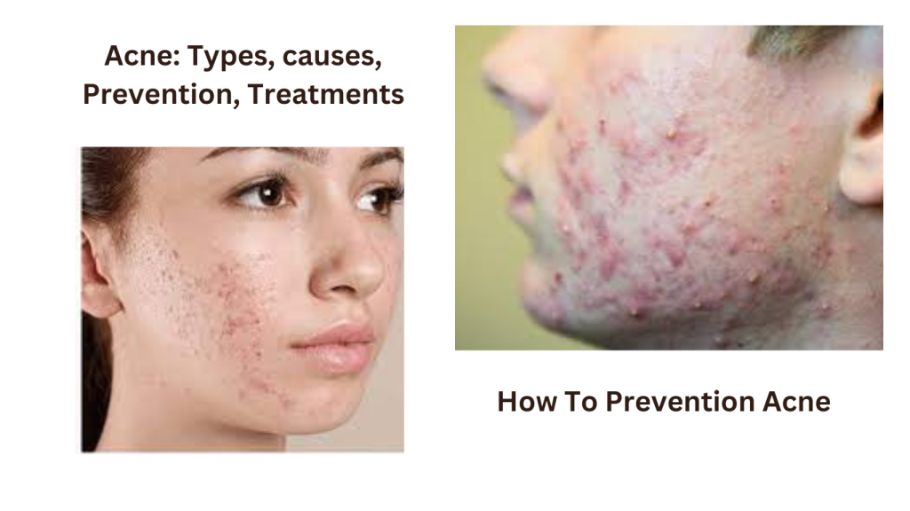 Content image for Battling Stubborn Acne? Understand the Causes, Types, and Effective Treatments