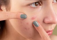 Featured image for Fading Acne Scars? Discover Effective Ways to Minimize and Eliminate Them